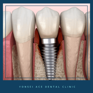 남가좌동임플란트