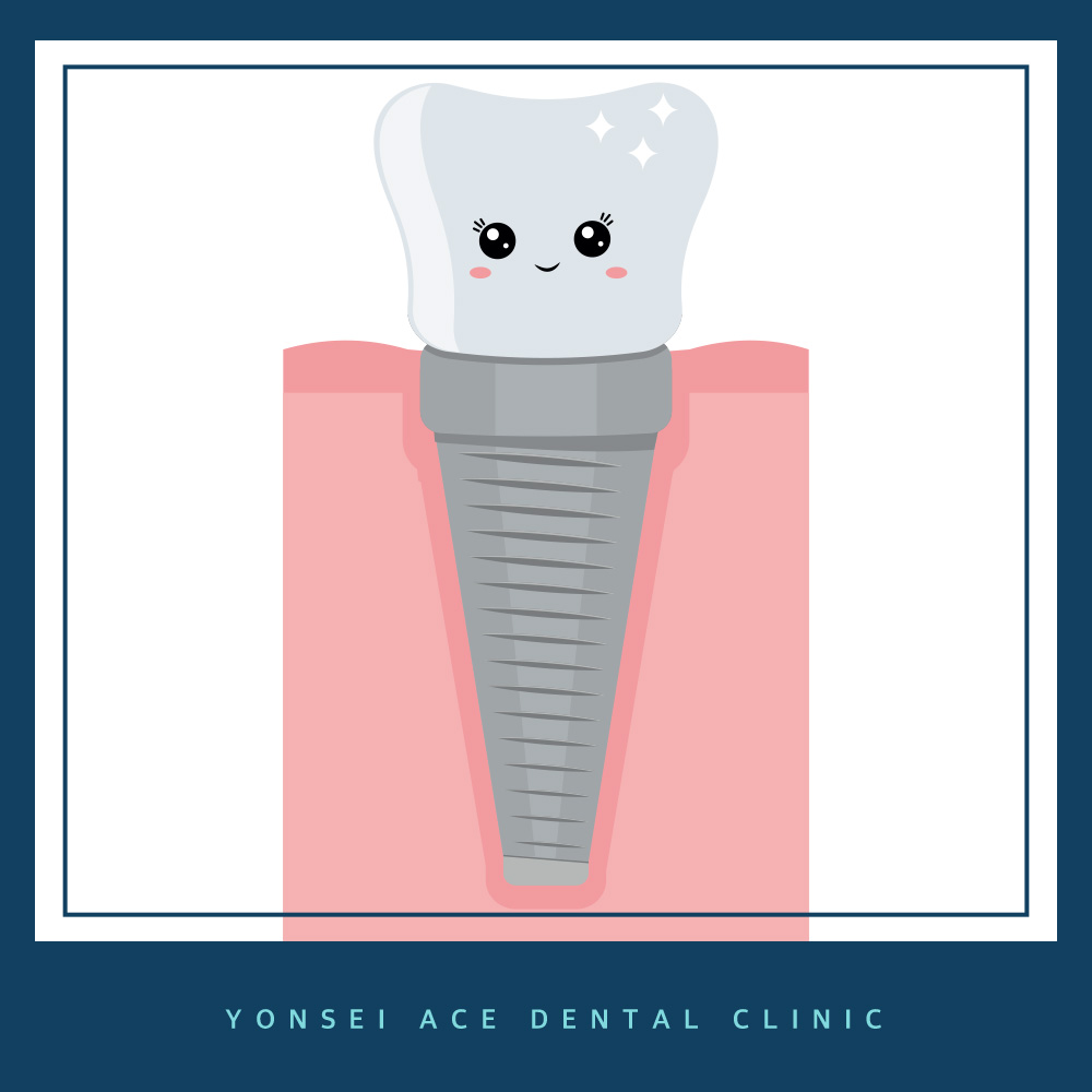 서대문구임플란트