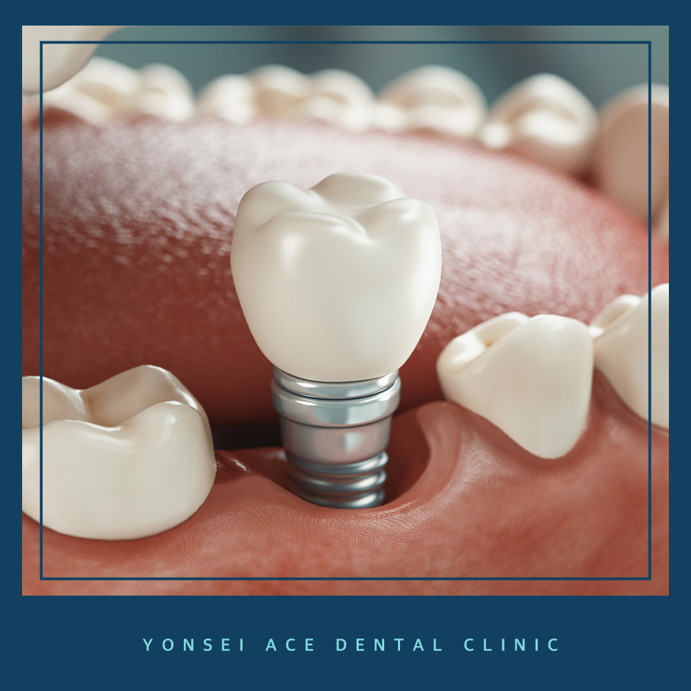 서대문구임플란트