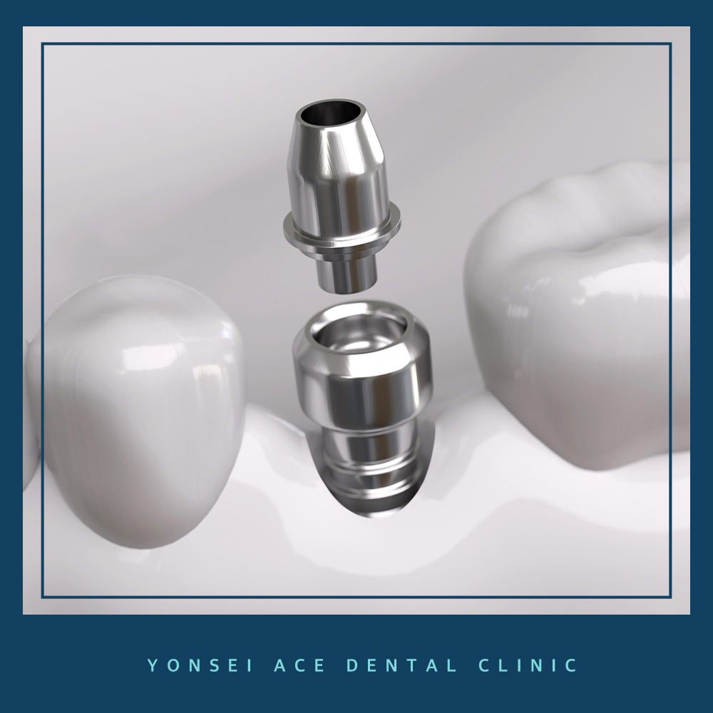 서대문구임플란트