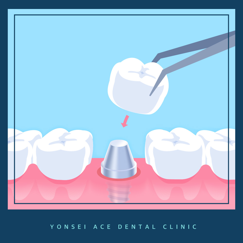 서대문구임플란트