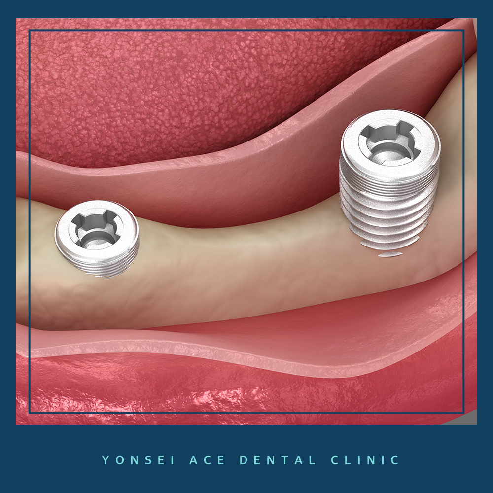 서대문구임플란트