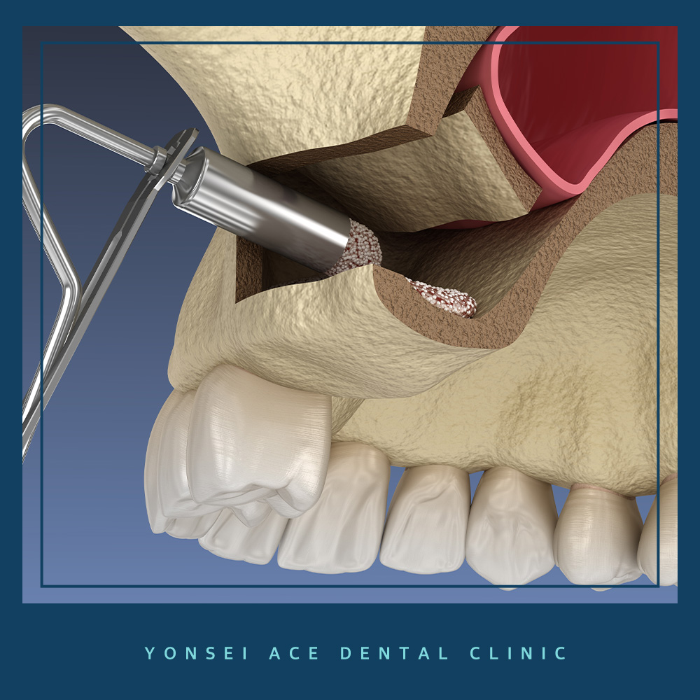 서대문구임플란트