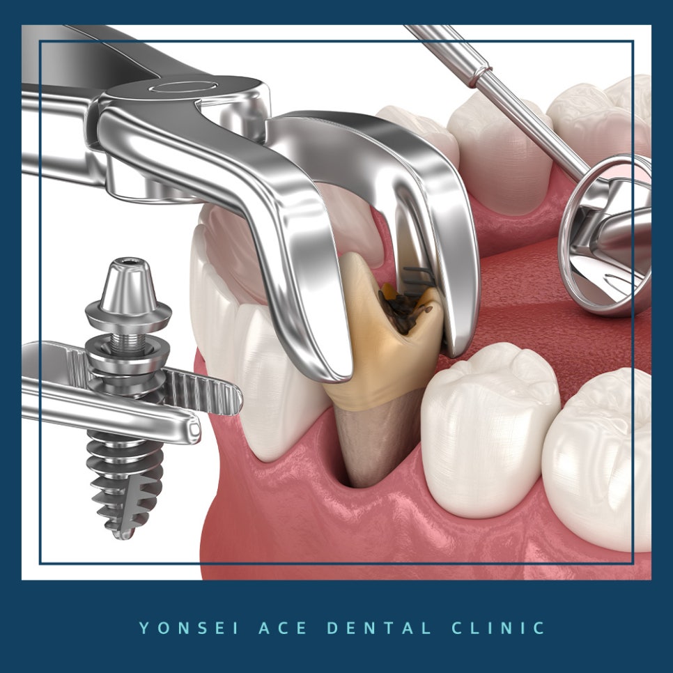 서대문구임플란트