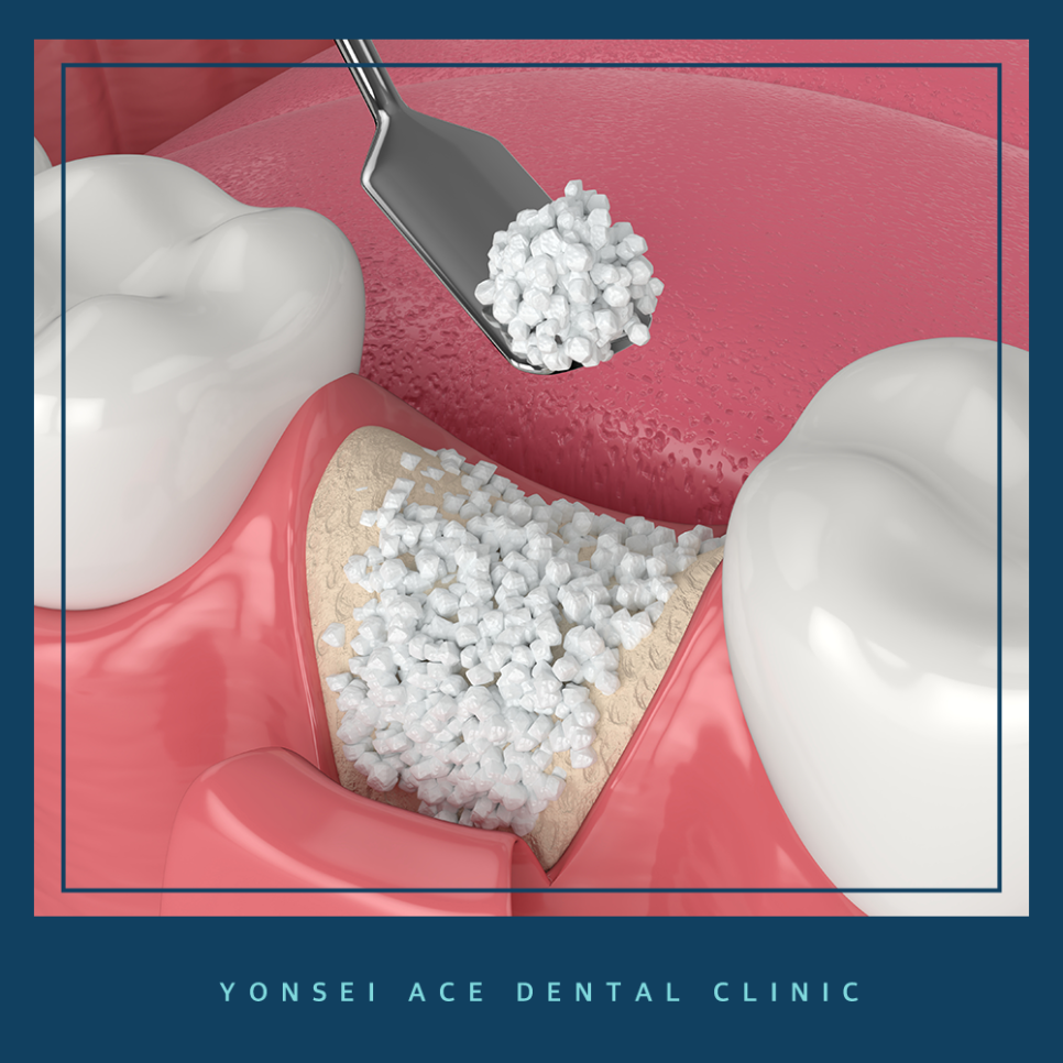 서대문구임플란트