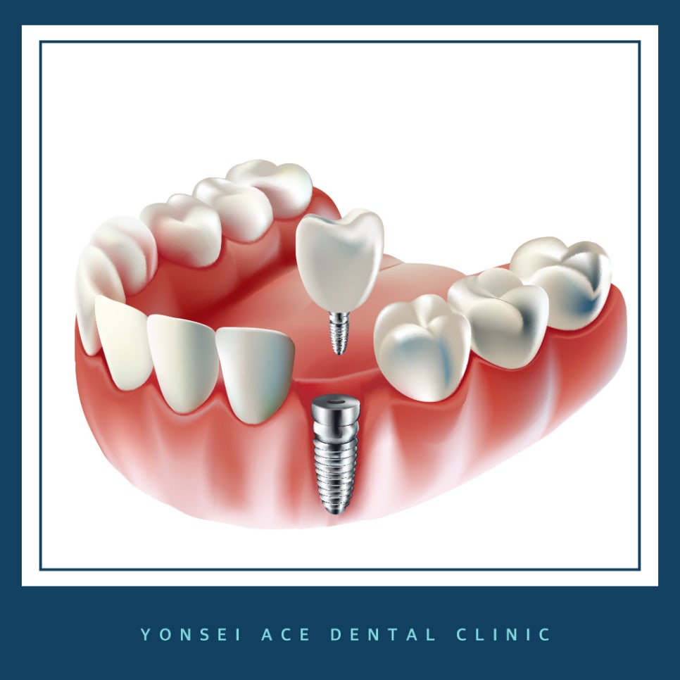 서대문구임플란트