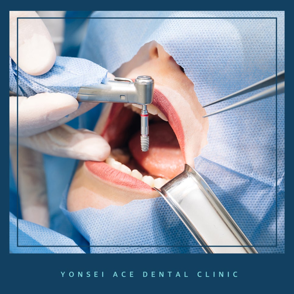 서대문구임플란트