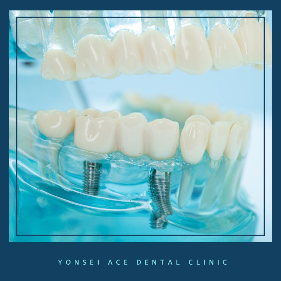 서대문구임플란트