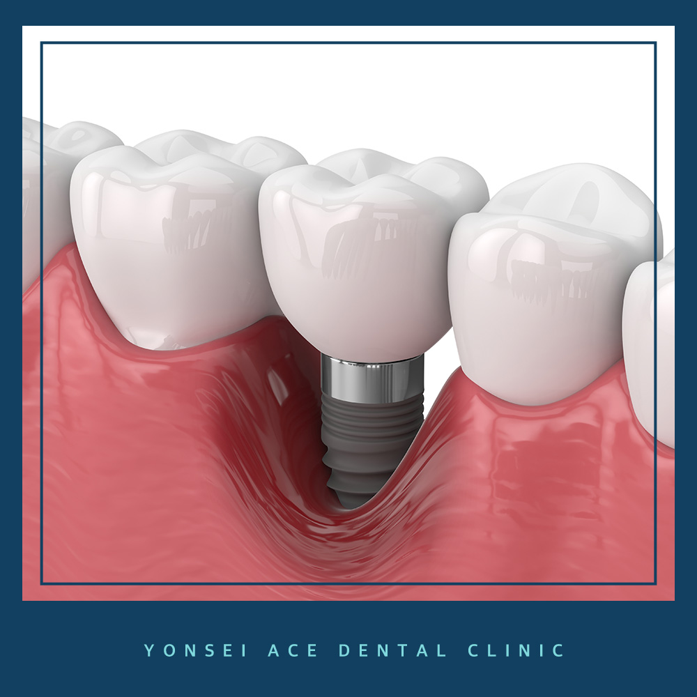 남가좌동임플란트