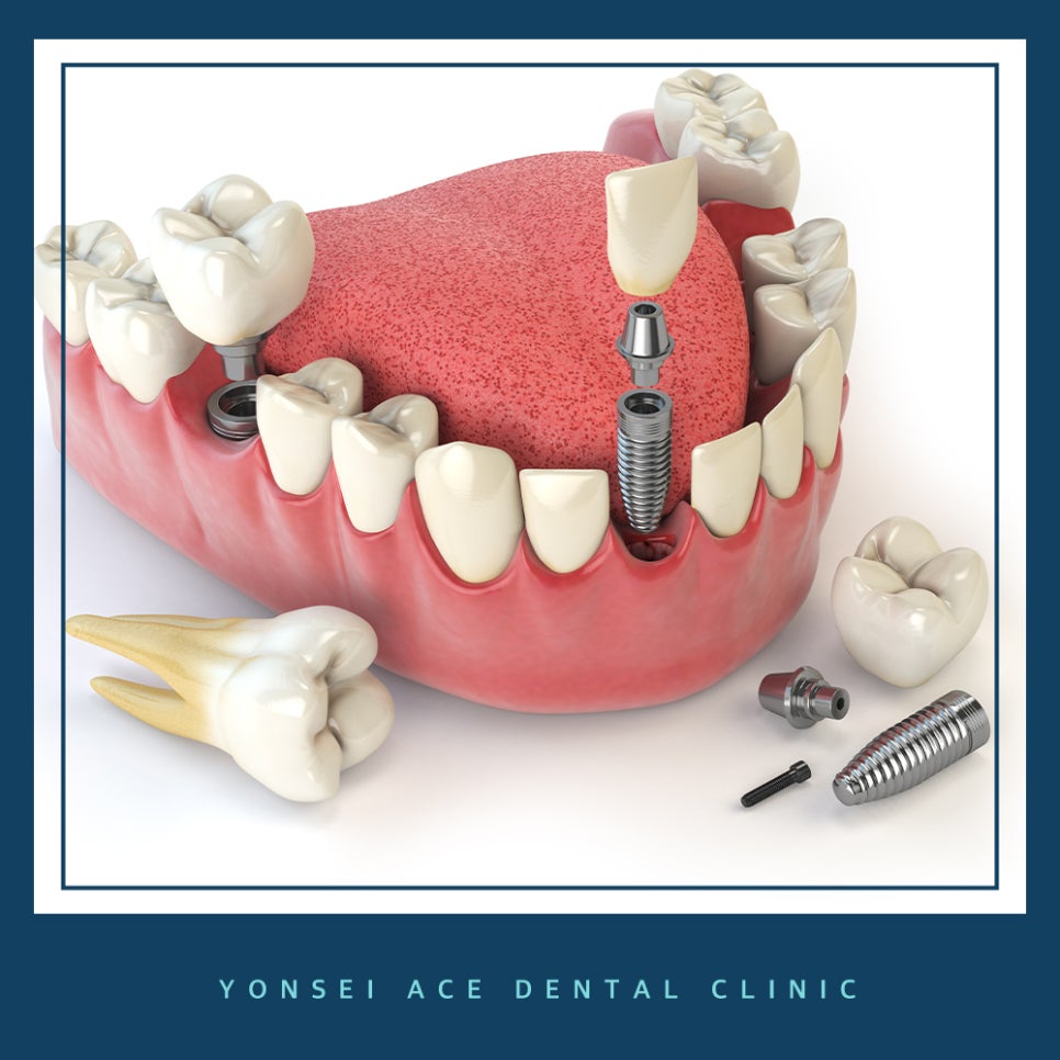 서대문구임플란트