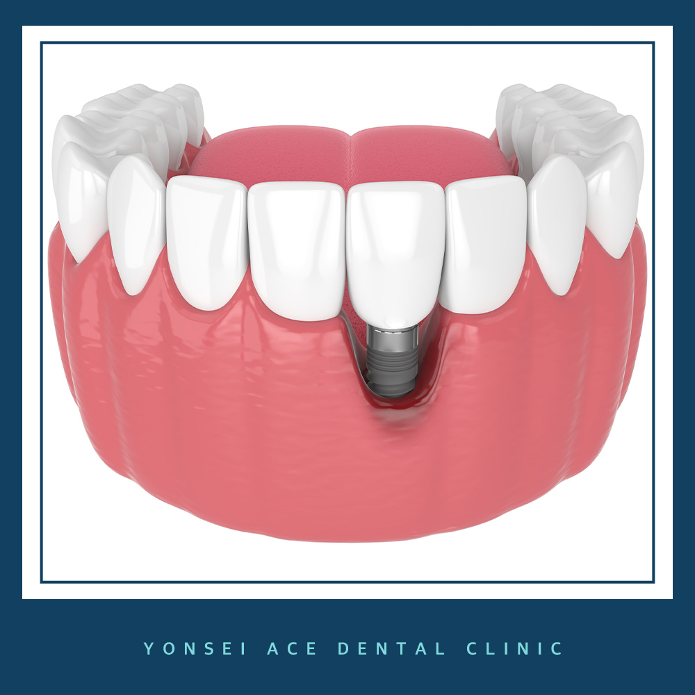 서대문구임플란트