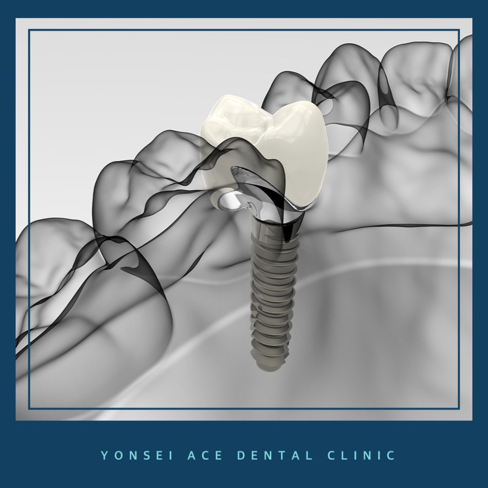 서대문구임플란트