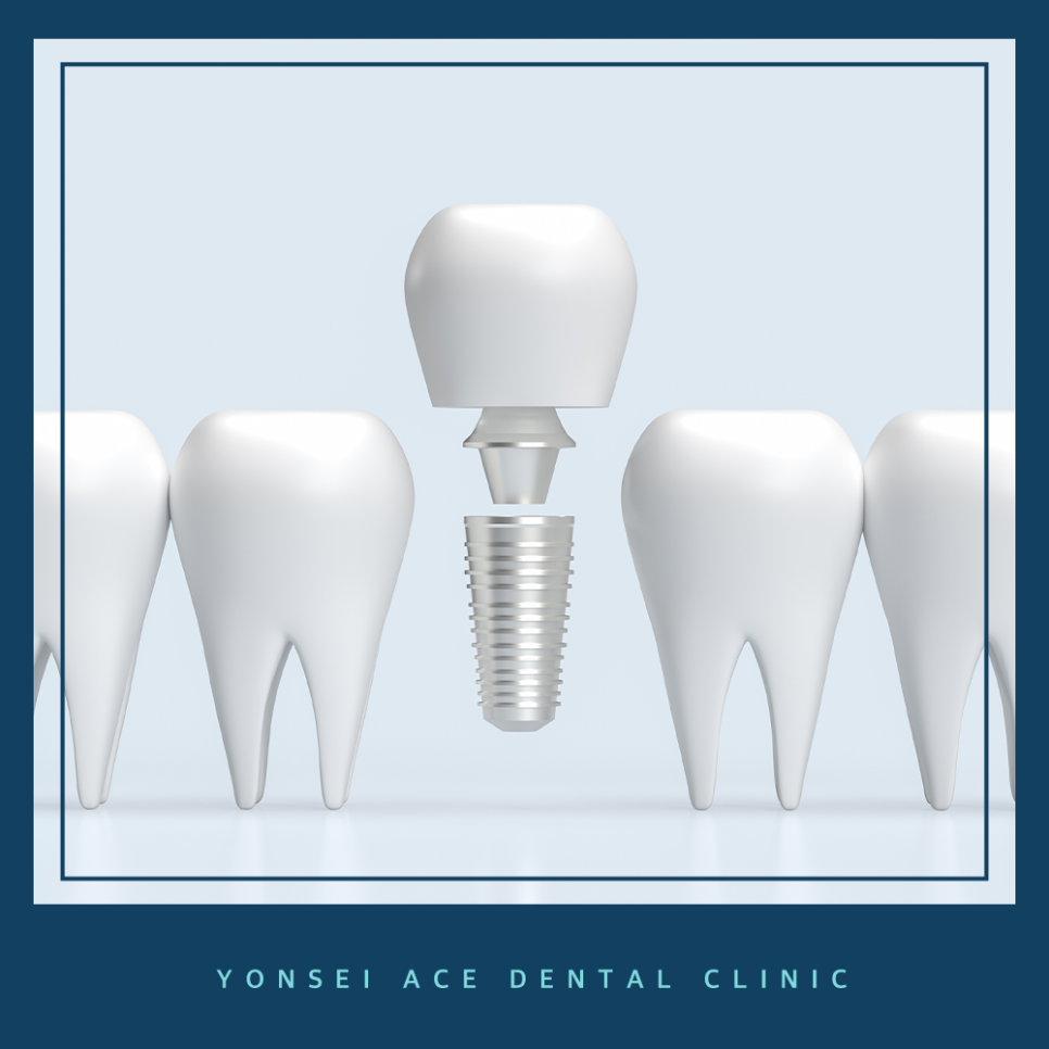 서대문구임플란트