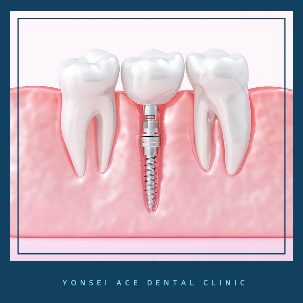 남가좌동임플란트