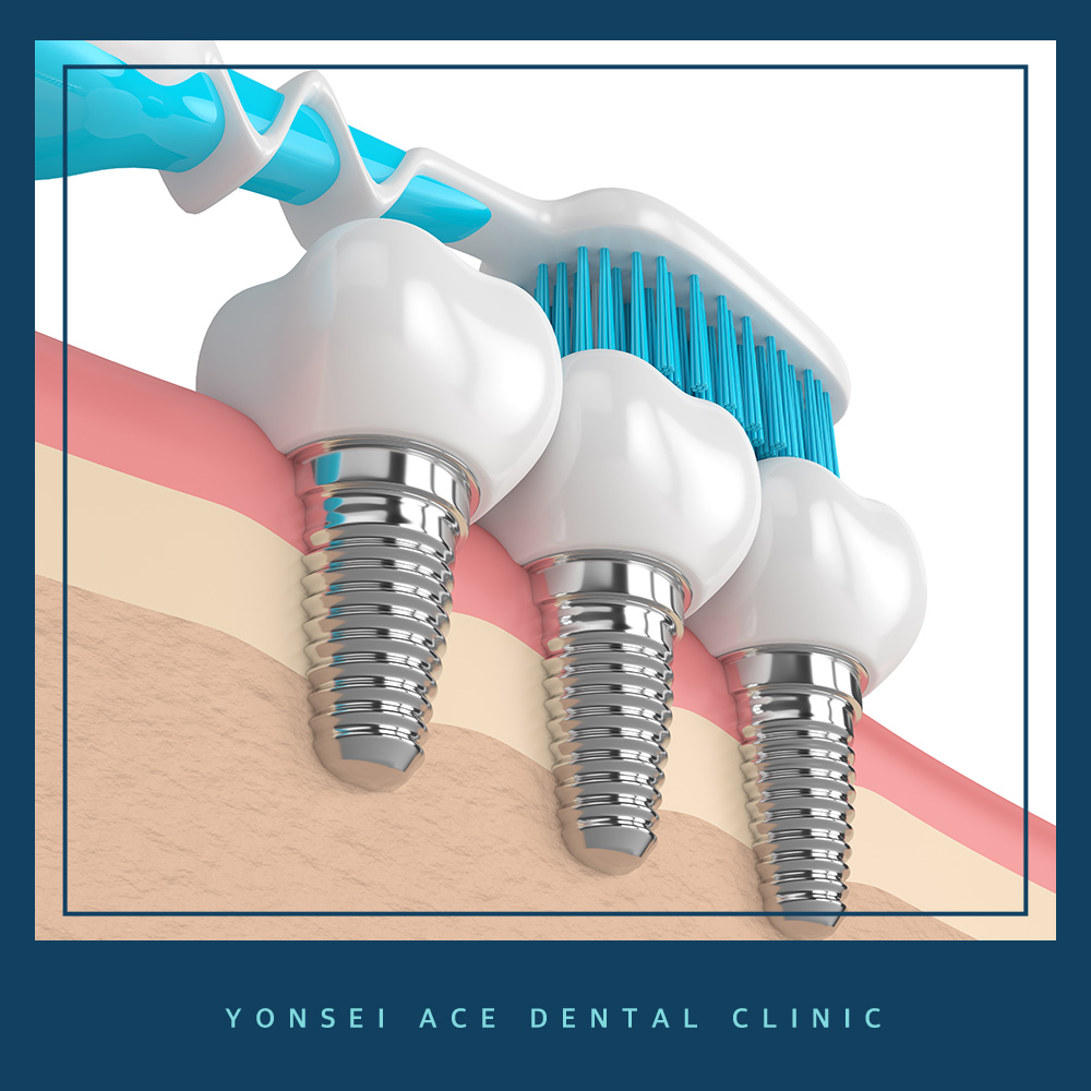 서대문구임플란트