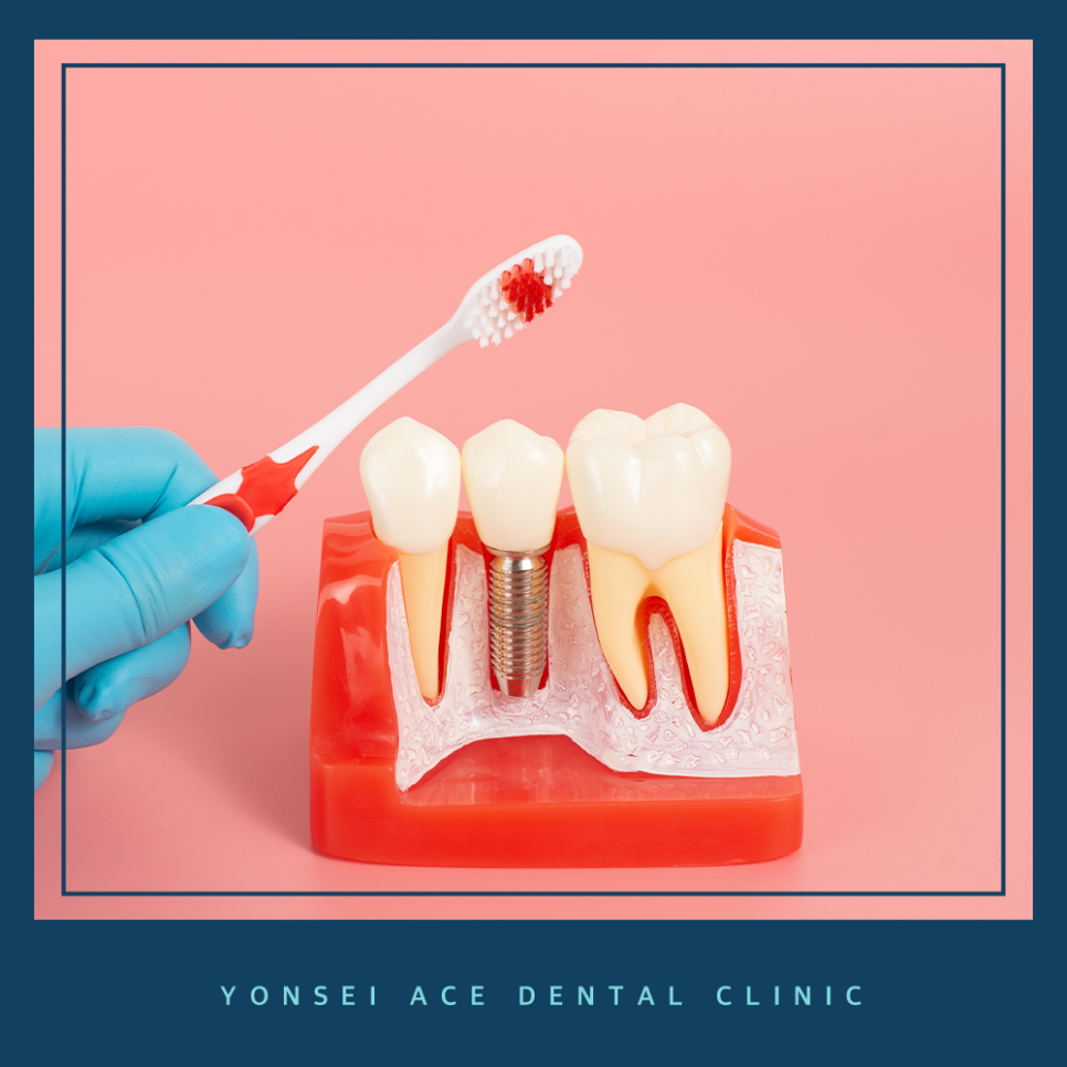 서대문구임플란트