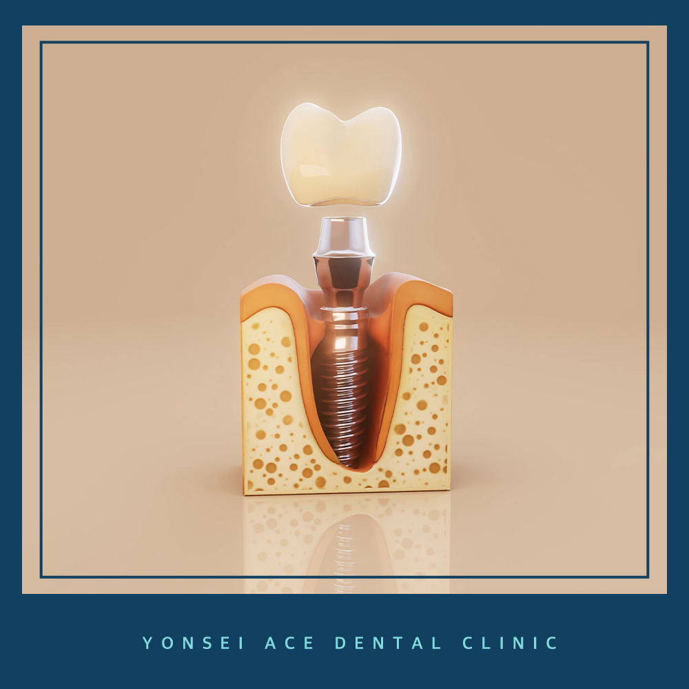 서대문구임플란트